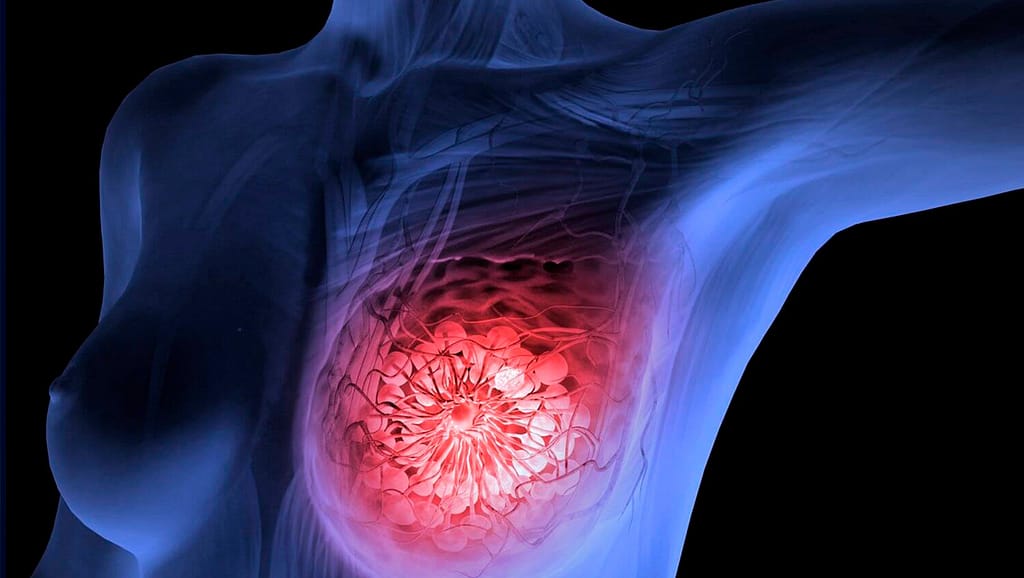 Jak wyglada rak piersi