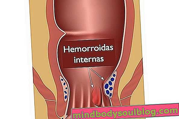 Pierwsze objawy hemoroidów
