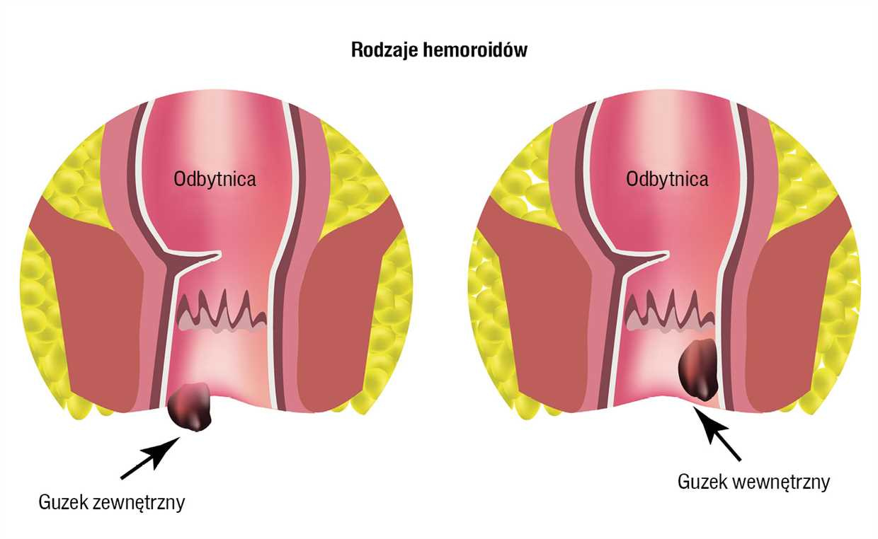 Diagnozowanie i klasyfikowanie hemoroidów