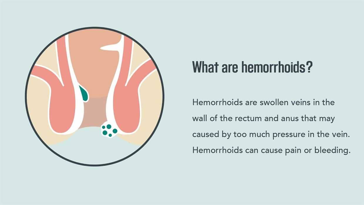 Hemoroidy leczenie