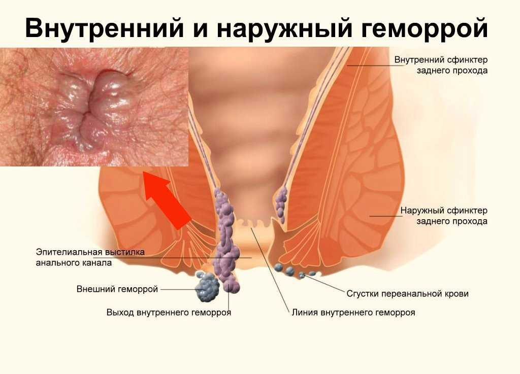 Objawy hemoroidów